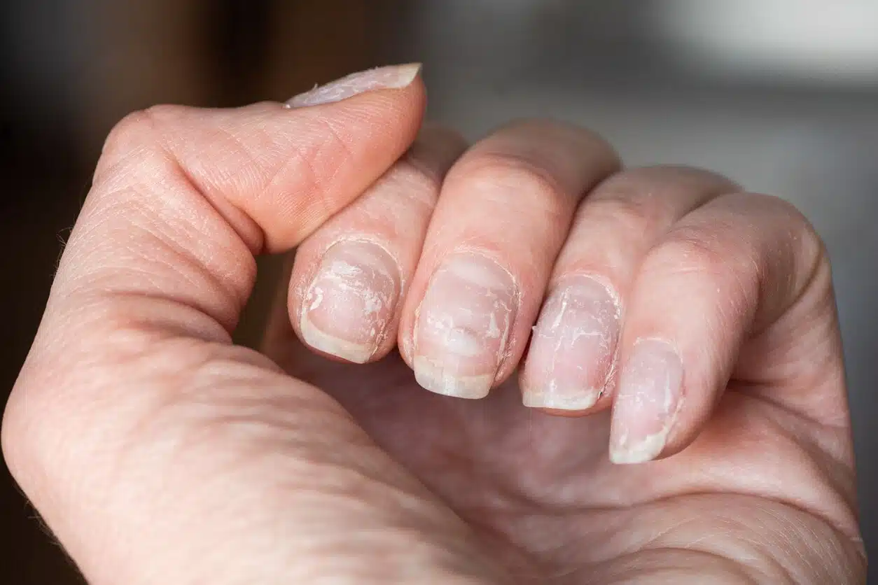 Ongles bosselés