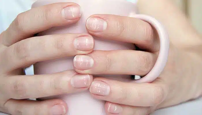 Ongles avec stries blanches
