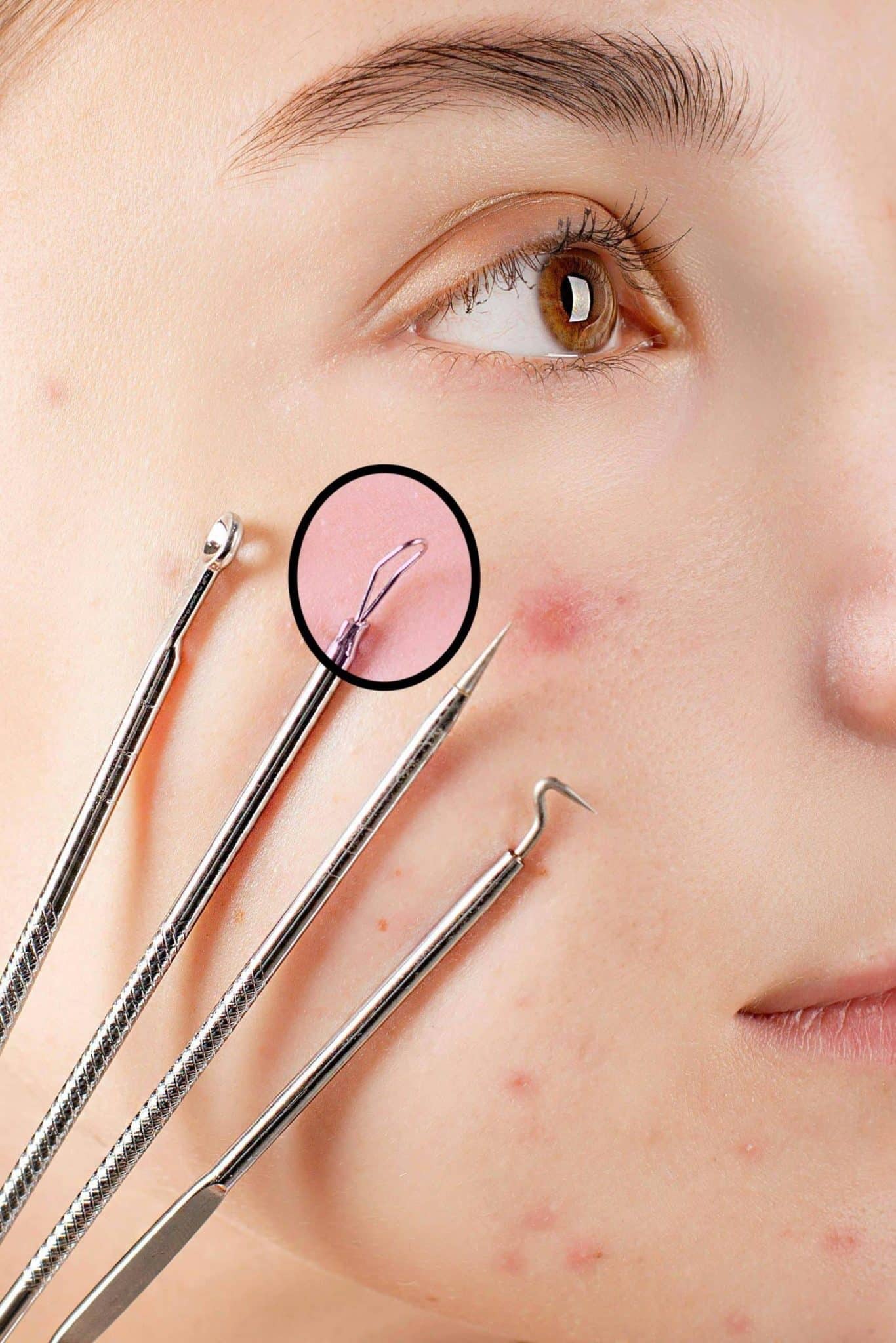 Dermatologue réalisant une extraction de milium