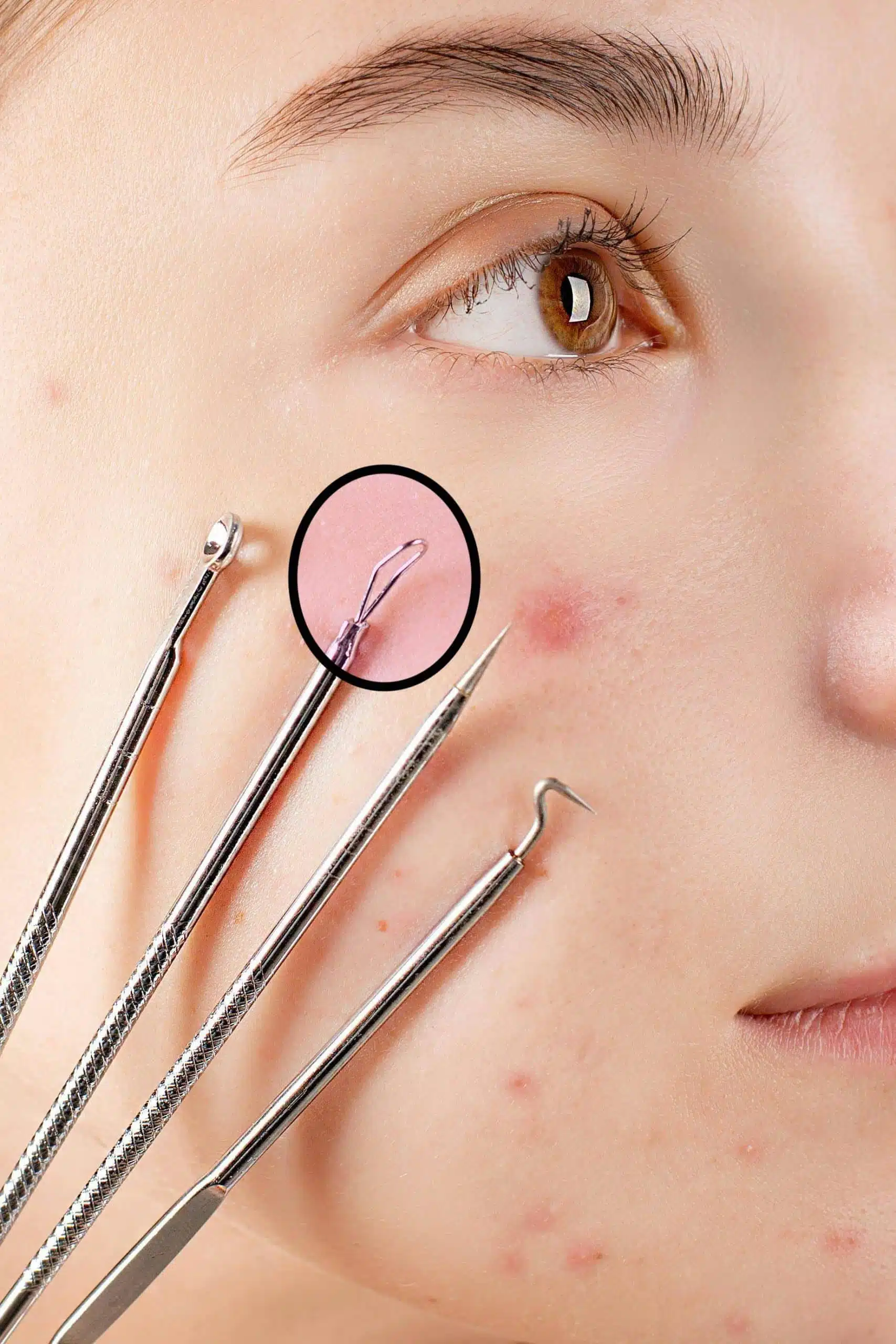 Dermatologue réalisant une extraction de milium