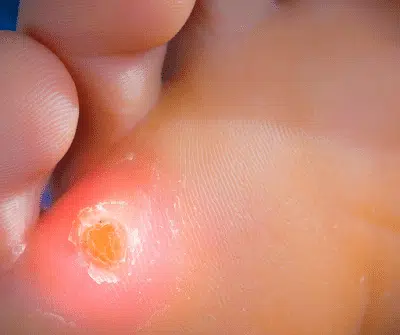 Illustration de durillon au pied