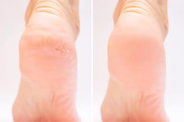 Transformation de pieds secs en pieds doux après traitement