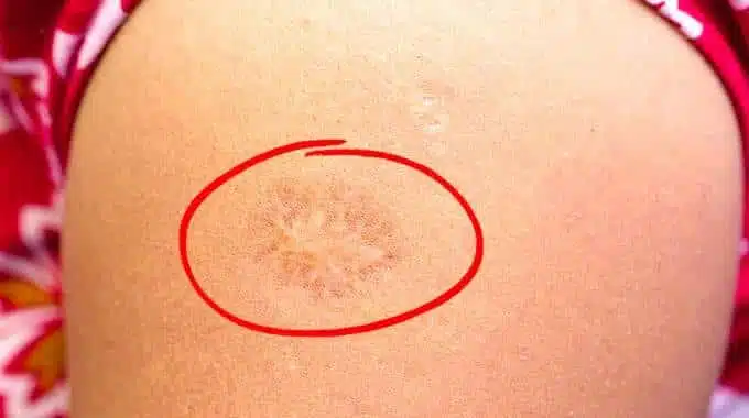 Exemple de cicatrice de vaccination