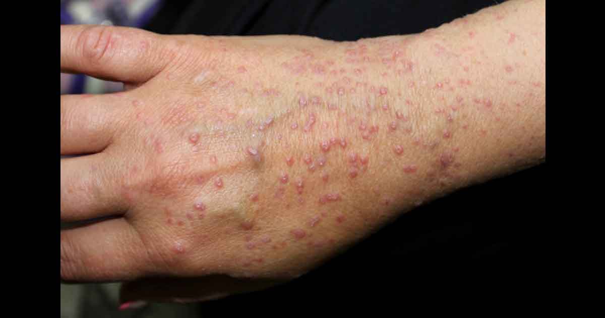 Lichen plan sur la peau