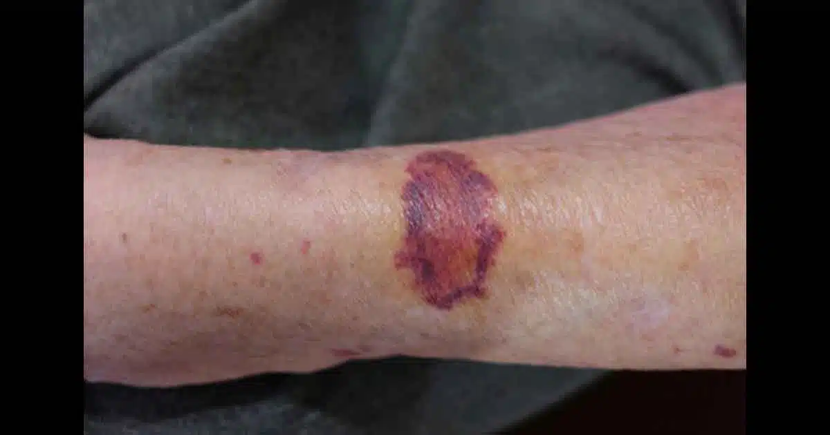 Purpura sur la peau