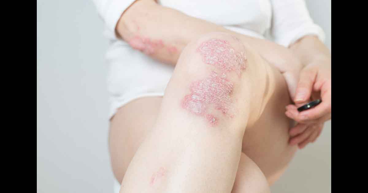 Psoriasis sur la peau