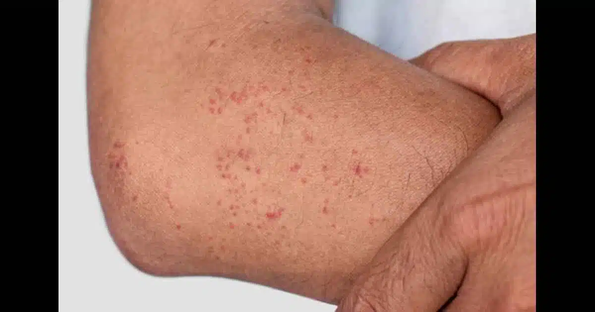 Soins de la peau