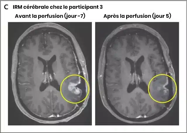 Imagerie médicale montrant une tumeur