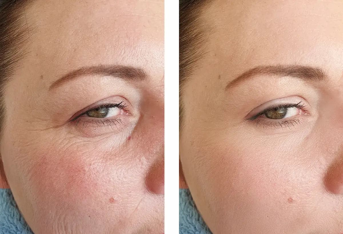 Comparaison avant/après traitement de la peau