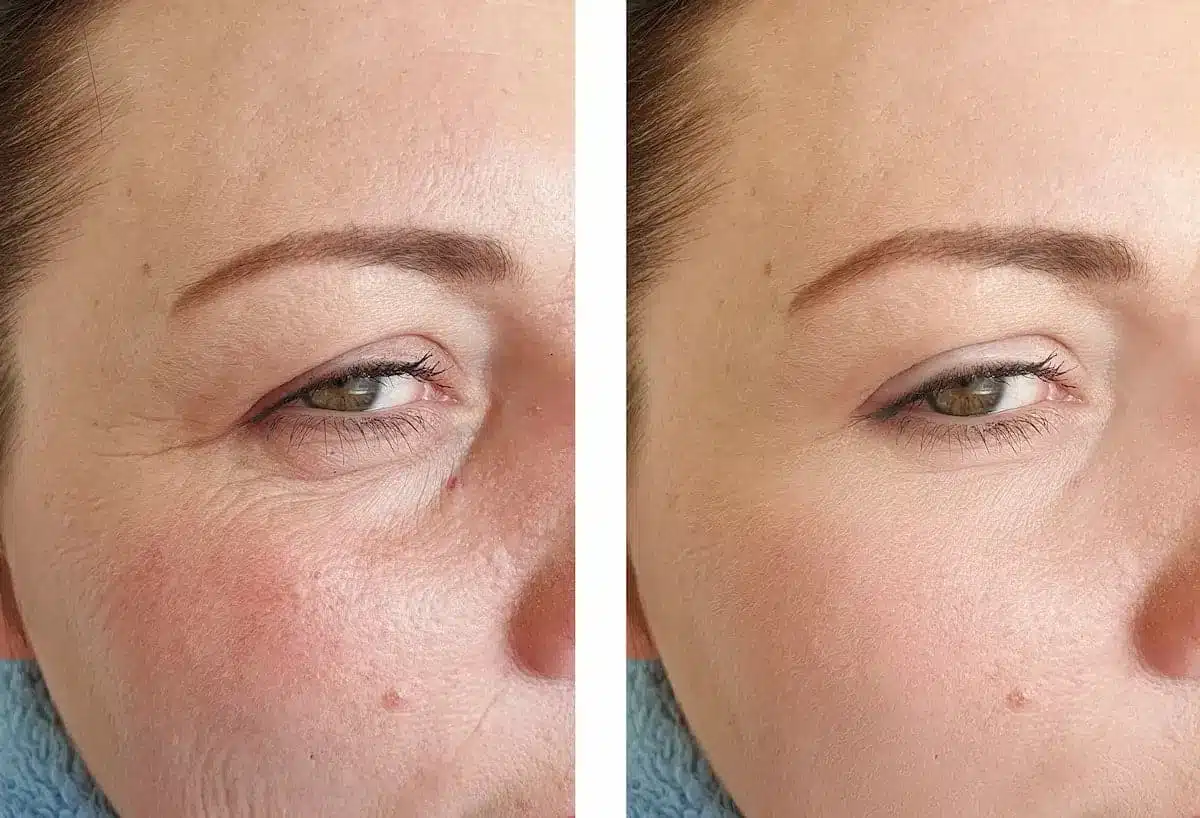 Comparaison avant/après traitement de la peau