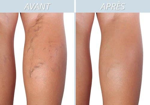 Femme massant ses jambes