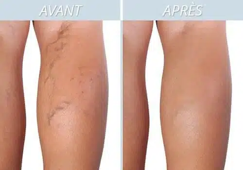 Femme massant ses jambes