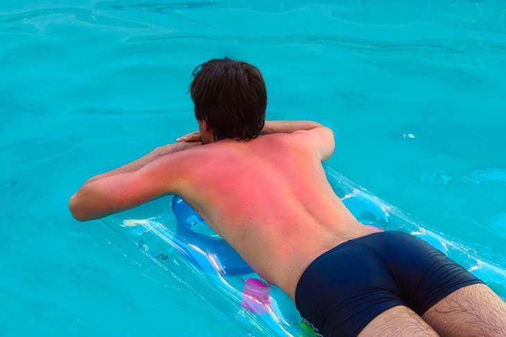 S'exposer au soleil sans protection peut provoquer une brûlure au premier degré. source : spm