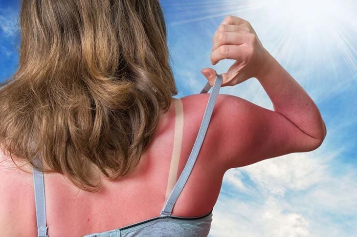 Coup de soleil. source : spm