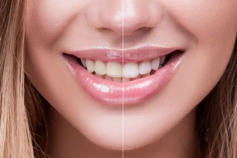 Comparaison avant/après blanchiment dentaire naturel