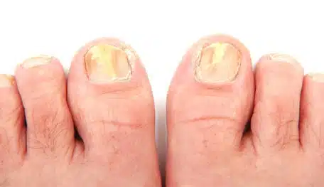 Ongles atteints de mycose
