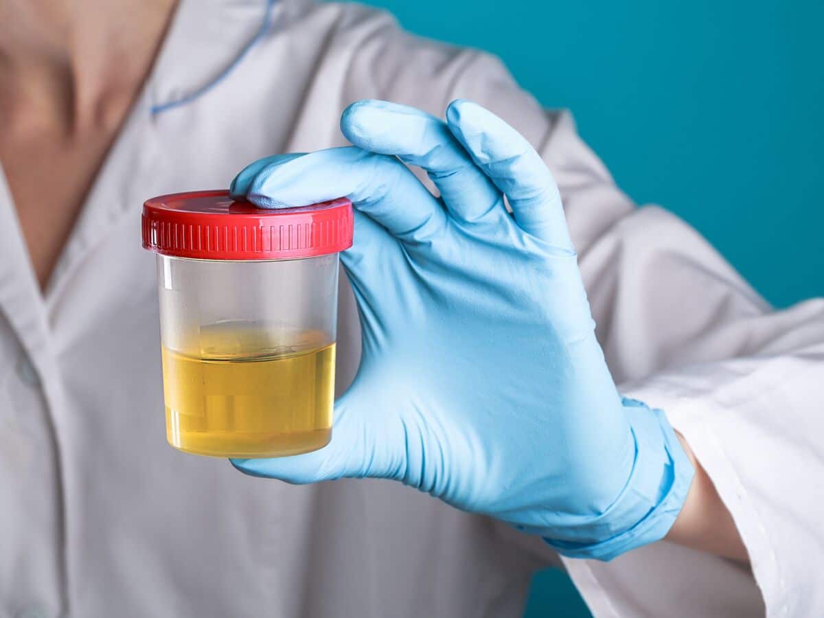 Illustration d'urine trouble