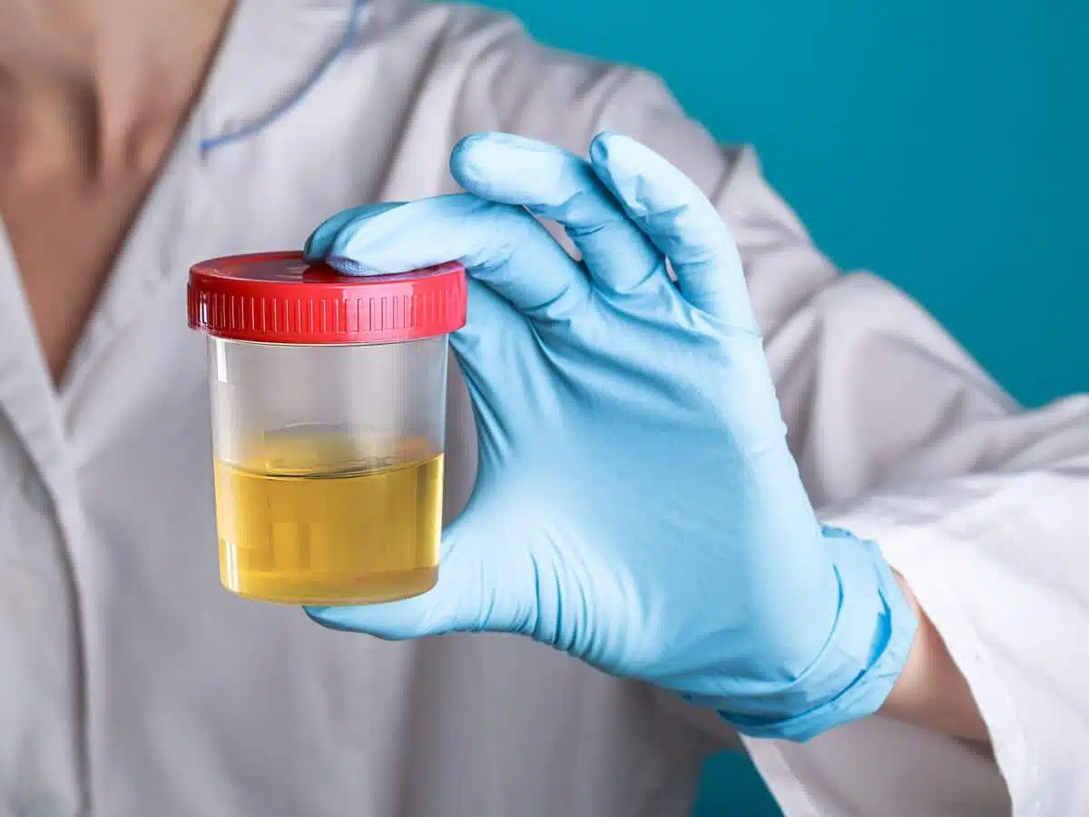 Illustration d'urine trouble