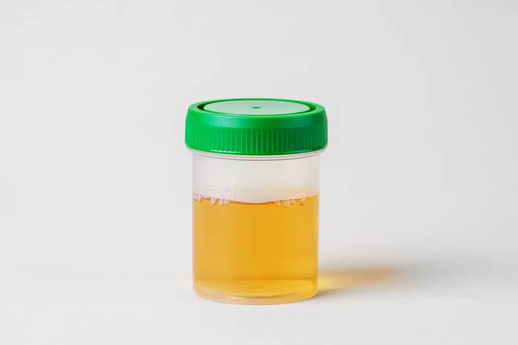 Illustration d'urine jaune vif