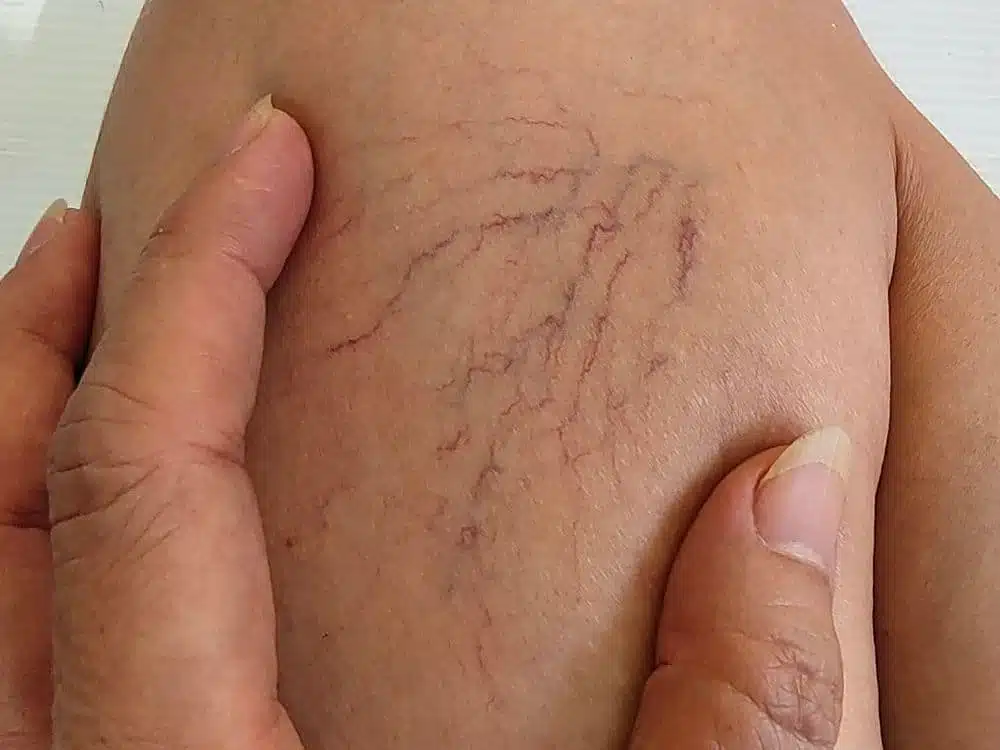 Illustration de varices sur les jambes