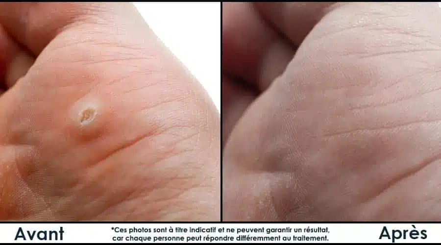 Différents types de verrues