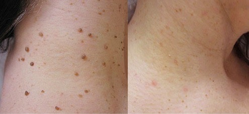 Comparaison avant/après traitement naturel