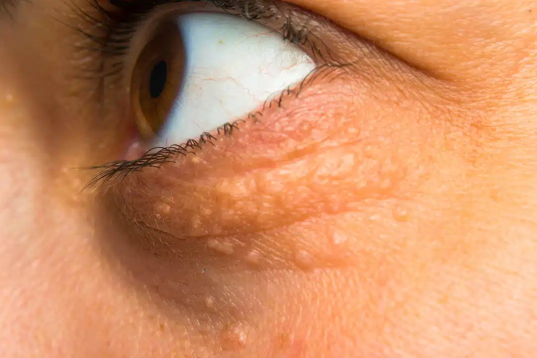 Détail d'un xanthélasma près de l'œil