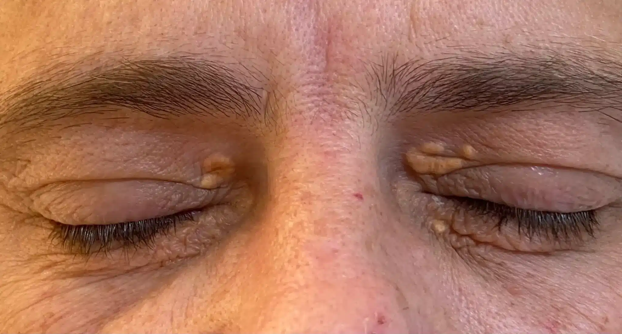 Traitement médical du xanthélasma